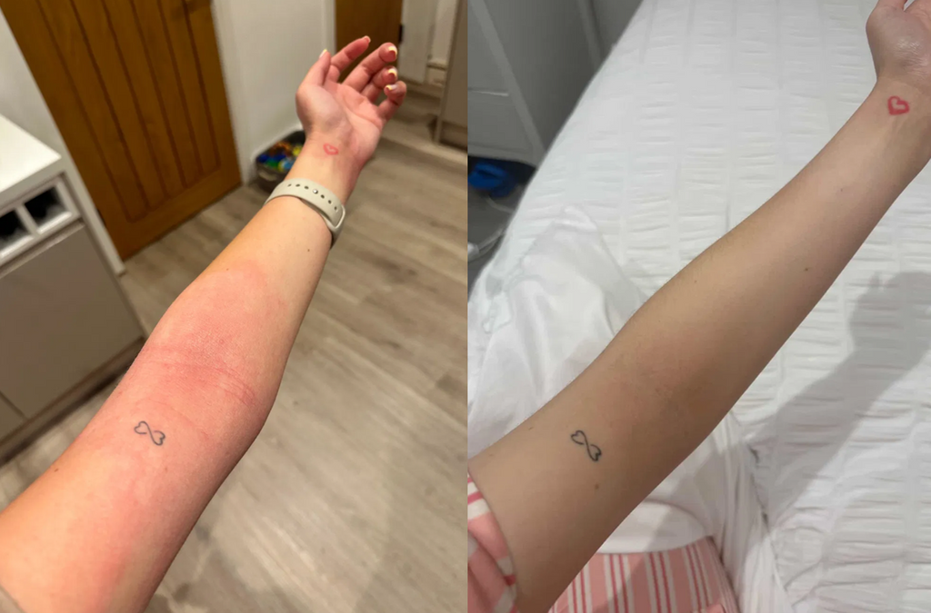 Can Hard Water Cause Eczema or Sensitive Skin Flare-Ups?