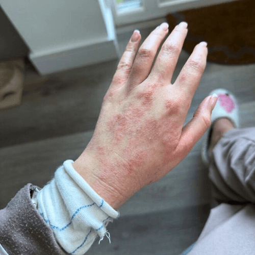 How Tap Water Affects Your Skin