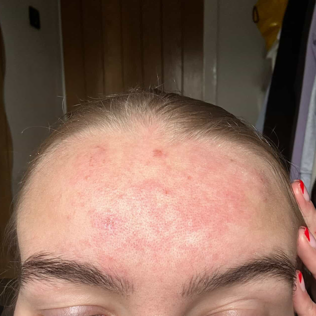 Can Shower Water Cause Breakouts?